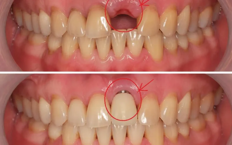 [경산 명치과] myungdental - 발치 즉시 임플란트 (7)