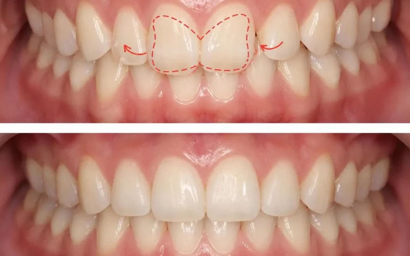 [경산 명치과] myungdental - 부분교정 - 나비모양 앞니 비틀림 교정2