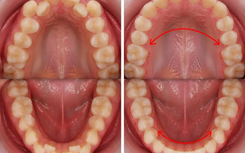 [경산 명치과] myungdental - 소아교정 - 비교 영구치 공간부족