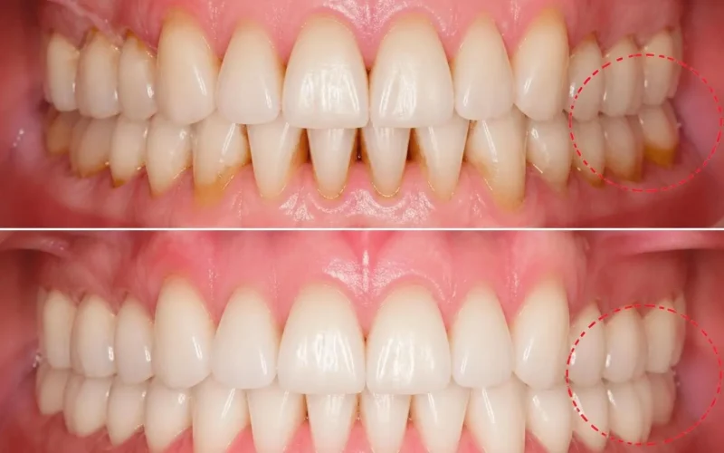 [경산 명치과] myungdental - 시멘트리스 임플란트 보철 - 어금니 염증 예방 보철 케이스