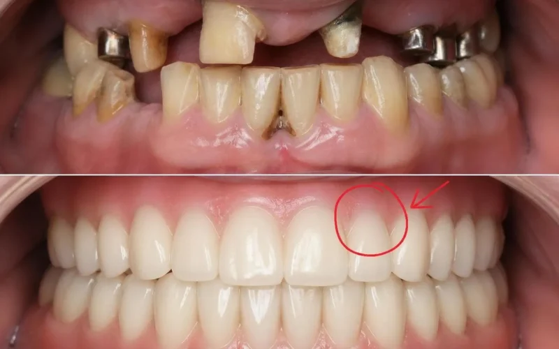 [경산 명치과] myungdental - 임플란트 틀니 - 상악 다수 치아 상실 복합 치료